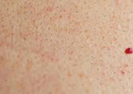 تحذير .. الشامات الحمراء علامة على الإصابة بسرطان الجلد