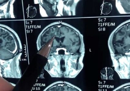 دودة بقيت في رأس صيني 30 عاما