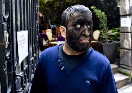 أطفال يتحولون إلى ذئاب بسبب دواء ملوث