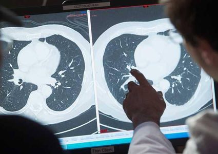 تقنية طبية تعطي أمل لمرضى السرطان