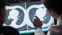 تقنية طبية تعطي أمل لمرضى السرطان