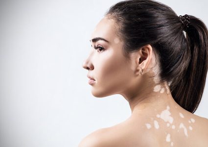 لماذا يصاب الجسم بالبهاق ؟