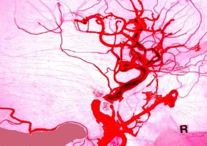 عوامل تعلم على تدمير الأوعية الدموية