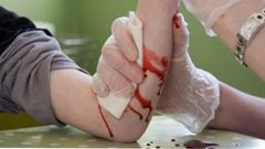 ضمادة إلكترونية تساعد في التئام الجروح أضعاف التقليدية