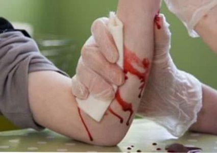 ضمادة إلكترونية تساعد في التئام الجروح أضعاف التقليدية