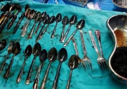 مصر.. استخراج 20 ملعقة ومجوهرات من بطن مريض