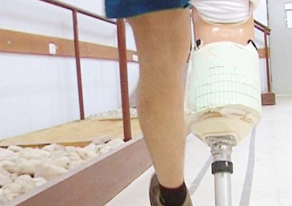 ابتكار جهاز جديد لمساعدة الأشخاص مبتوري الأطراف