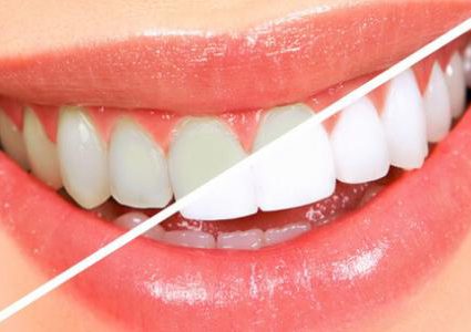 تبييض الأسنان رغم جهاز التقويم