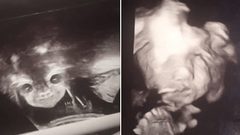 صورة "الجنين الشيطان" تنتشر على وسائل التواصل وتثير قلق والديه!