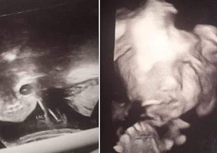 صورة "الجنين الشيطان" تنتشر على وسائل التواصل وتثير قلق والديه!