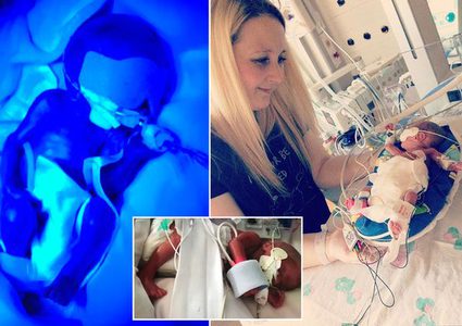 بعد 5 أشهر من الحيرة.. "الرضيع الشفاف" يبقى على قيد الحياة