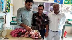 الهند.. ولادة طفلة بأربع أرجل و3 أياد
