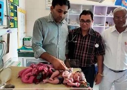 الهند.. ولادة طفلة بأربع أرجل و3 أياد