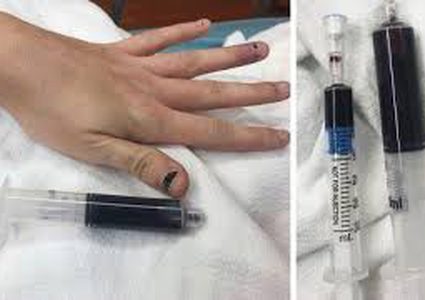 شابة تصدم بتحول دمائها إلى اللون الأزرق بعد وضعها كريم مخدر