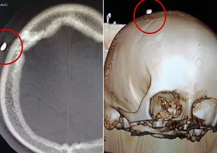 البرتغال.. سن يخترق رأس صبي تعرض للعض أثناء مباراة كرة قدم!