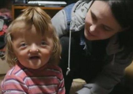 روسيا.. حضانة ترفض استقبال طفلة بسبب إصابتها بتشوه في الجمجمة !