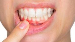 التهابات اللثة تزيد خطر الاصابة بضغط الدم