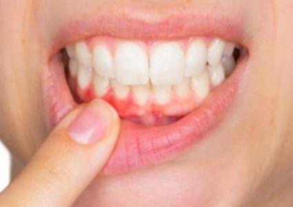 التهابات اللثة تزيد خطر الاصابة بضغط الدم