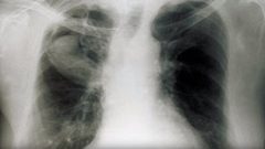 فطر يقتل كلباً ويصيب صاحبه بنوبات سعال شديدة