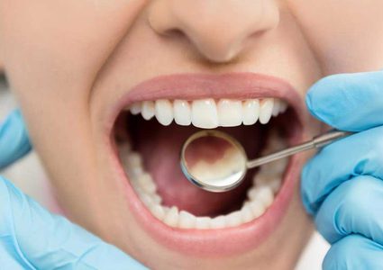 دراسة: النظام الغذائي النباتي قد يؤدي إلى تسوس الأسنان