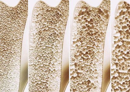 هشاشة العظام الخطر المتربص بالنساء