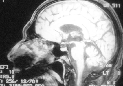 عادات تجنبها لتحمي نفسك من الإصابة بالزهايمر