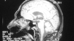 عادات تجنبها لتحمي نفسك من الإصابة بالزهايمر