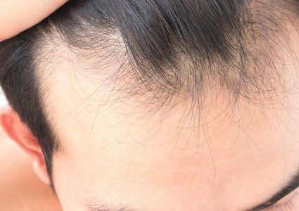 بنك للشعر لمكافحة الصلع!