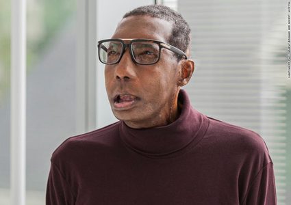 للمرة الأولى.. نجاح أول عملية زراعة وجه في العالم