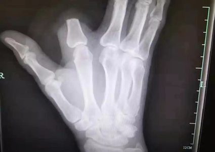 صيني يقطع إصبعه بسبب لدغة أفعى.. ثم يكتشف الكارثة !