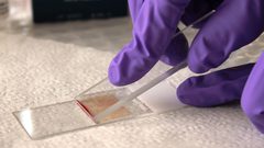 متى يطلب الطبيب منك إجراء مسحة الدم؟