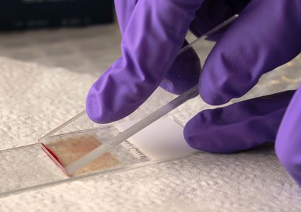 متى يطلب الطبيب منك إجراء مسحة الدم؟