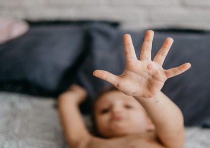 الحصبة تمحو "ذاكرة" جهاز المناعة