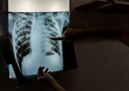 علاج للسل بتكلفة 1040 دولاراً للجرعة كاملة