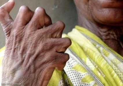 سيدة هندية تروي معاناتها بسبب عيب "كثرة الأصابع"
