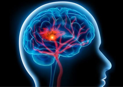 ما هي أنواع السرطانات التي تزيد خطر السكتات الدماغية ؟