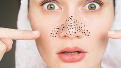 أهم الطرق الطبيعية لإزالة الرؤوس السوداء