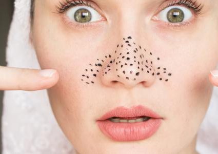 أهم الطرق الطبيعية لإزالة الرؤوس السوداء