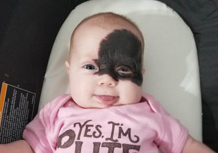 "طفلة باتمان" تبدأ رحلة العلاج للتخلص من وحمة الولادة