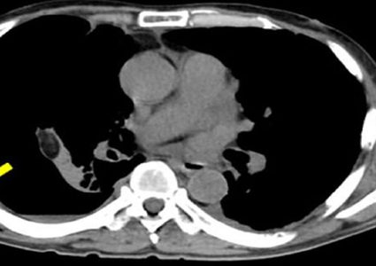 تضخم فقاعة هوائية تحت الجلد يسبب آلاماً شديدة