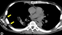 تضخم فقاعة هوائية تحت الجلد يسبب آلاماً شديدة