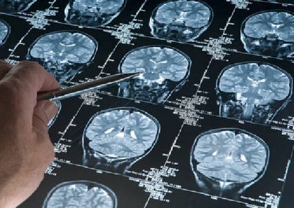 خطوة هامة نحو علاج مرض فقدان الذاكرة المدمر