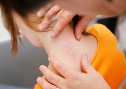 علماء: مرض الصدفية لا يقتصر على البالغين فقط