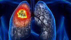 دراسة: مرضى سرطان الرئة الأكثر عرضة للاكتئاب