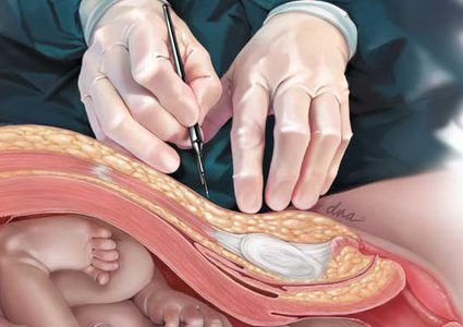 للمرة الأولى.. علماء يدحضون نظرية سمنة "أطفال العمليات القيصرية "