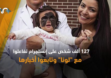 حالة نادرة جدا طفلة ولدت بقناع "باتمان" !