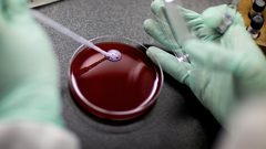 تغيير غريب ومفاجئ يطرأ على جسد رجل بعد زراعة نخاع عظم