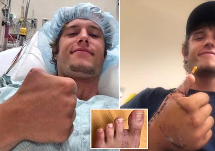 أطباء يوفرون بديل غريب لإبهام رجل فقده في حادث أثناء عمله !