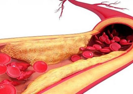 تحذير.. الدهون الزائدة في الدم قد تؤدي إلى تلف الأعضاء