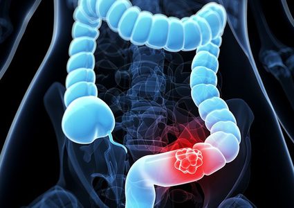 ما هي الأعراض الصامتة للإصابة بسرطان القولون ؟